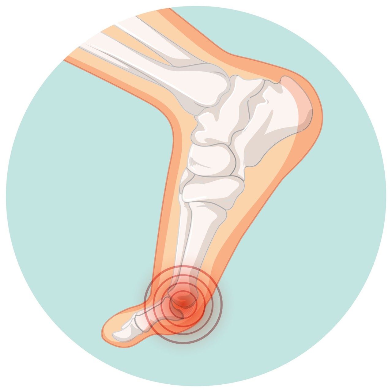 Joint Pain & Bunions